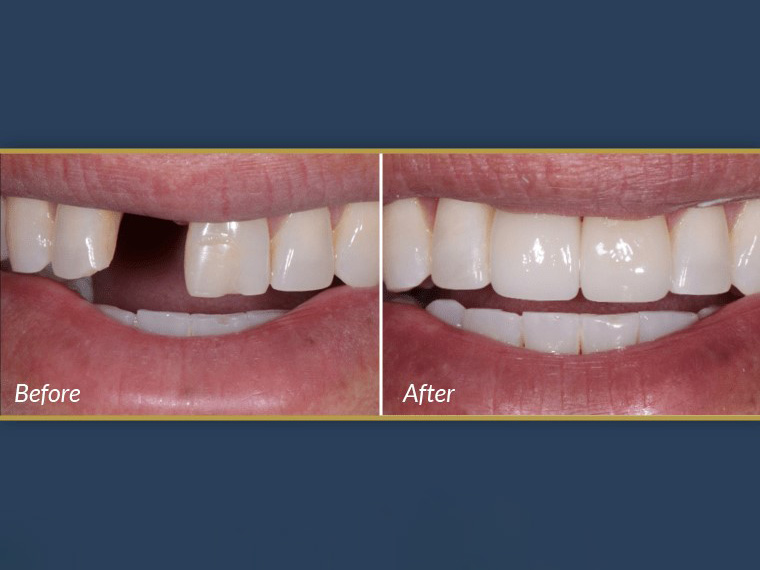 کاشت ایمپلنت برای پر کردن جای خالی دندان