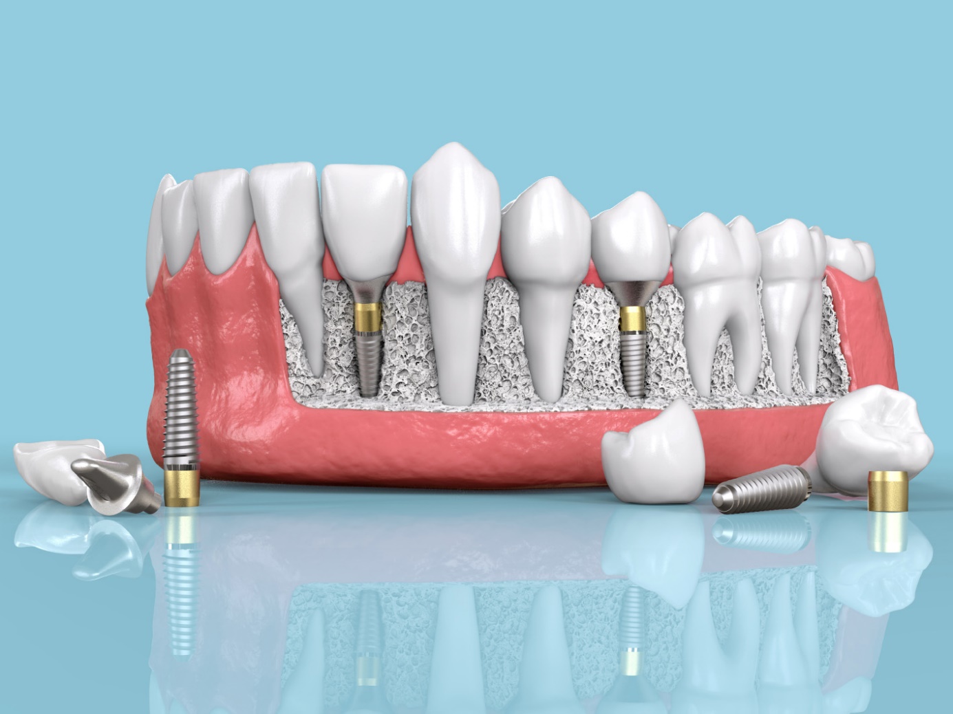 علت نیاز به ایمپلنت دندان